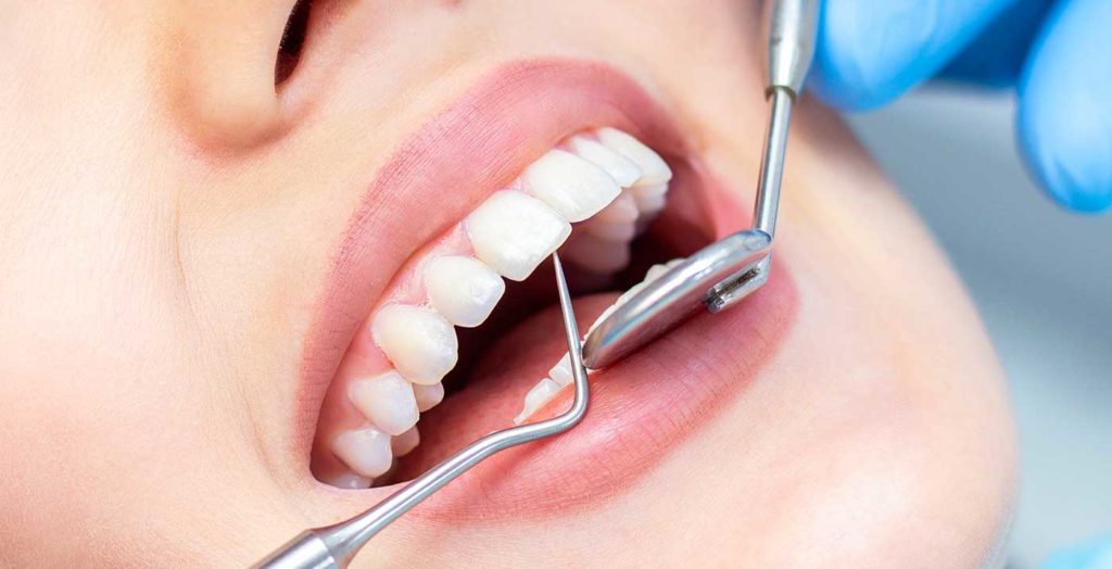 Votre dentiste Panadent à Domdidier pose des inlays et onlays dentaires.
