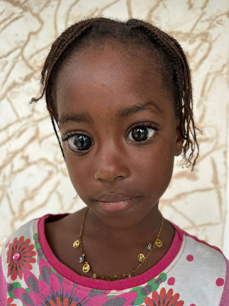 andre-mermoud-glaucome-congenital4