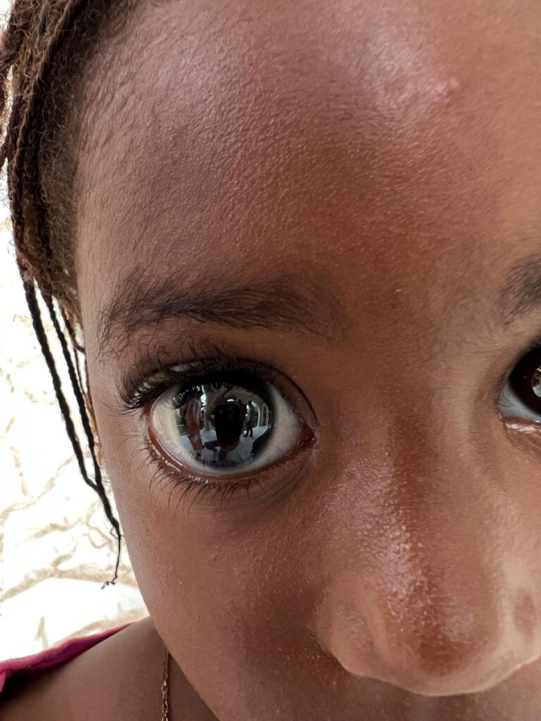 andre-mermoud-glaucome-congenital5