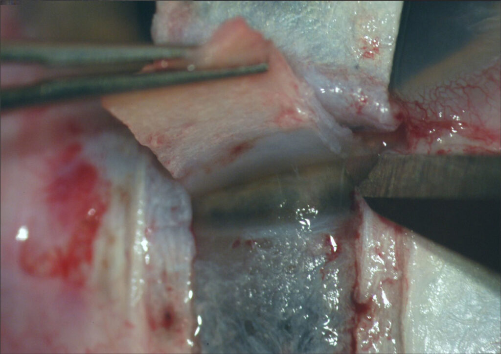 Sclérectomie profonde. Ouverture du canal de Schlemm et ablation du trabéculum juxtacanaliculaire
