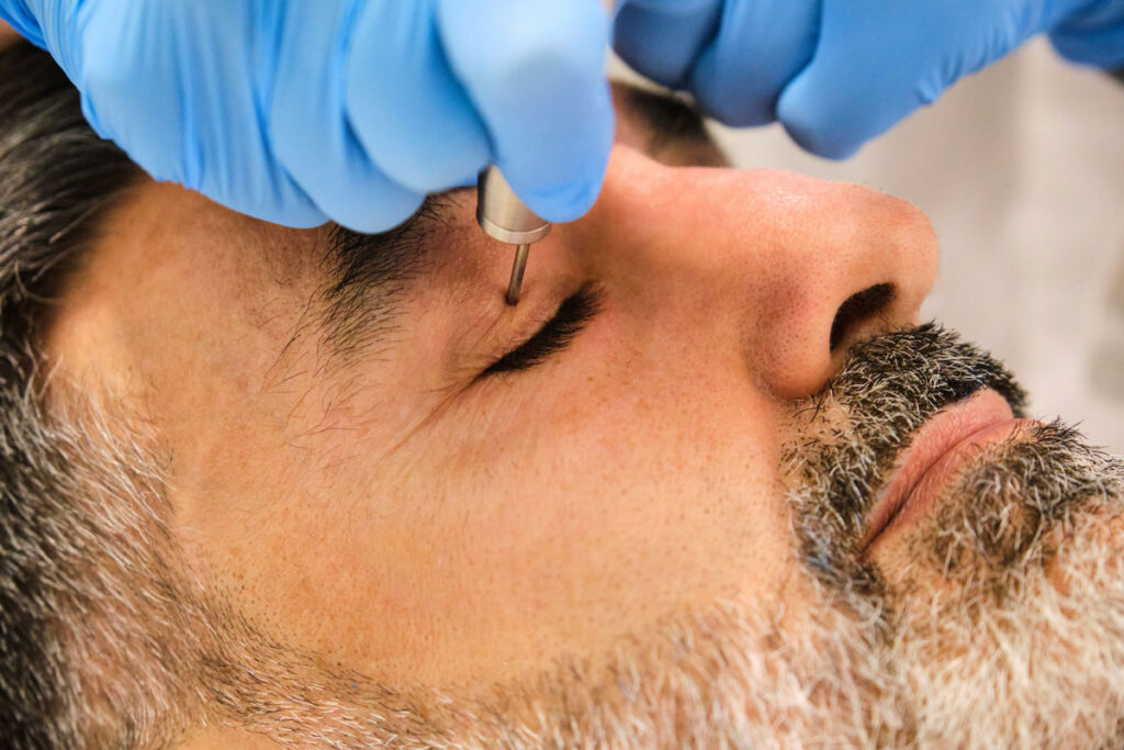 blépharoplastie-homme-paupiere