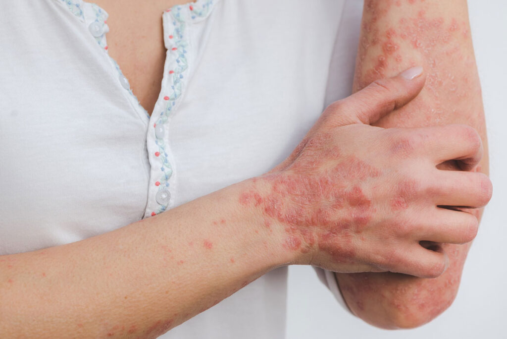 Femme souffrant de psoriasis