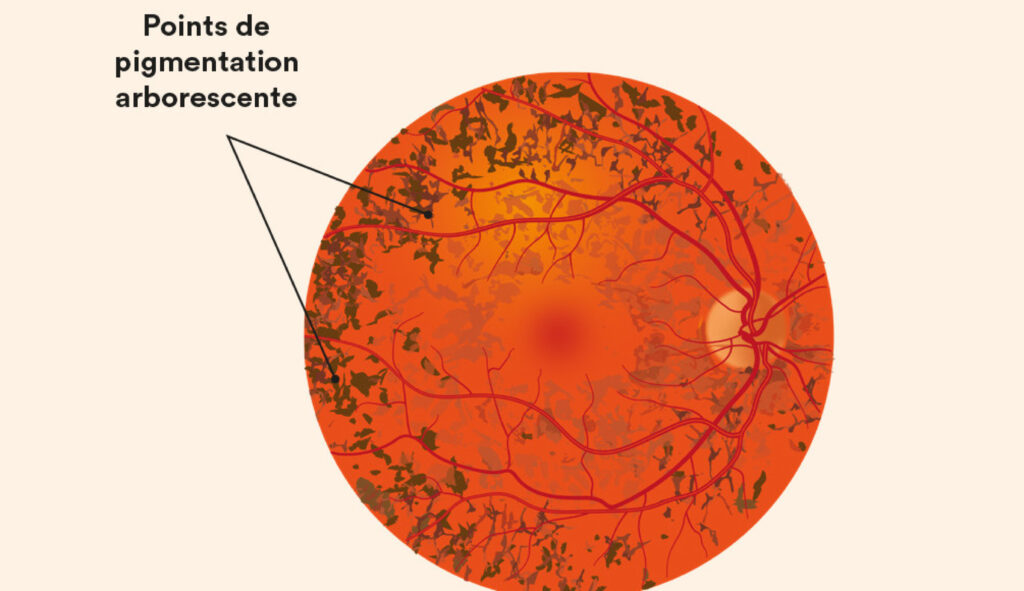 Schéma de rétinite pigmentaire