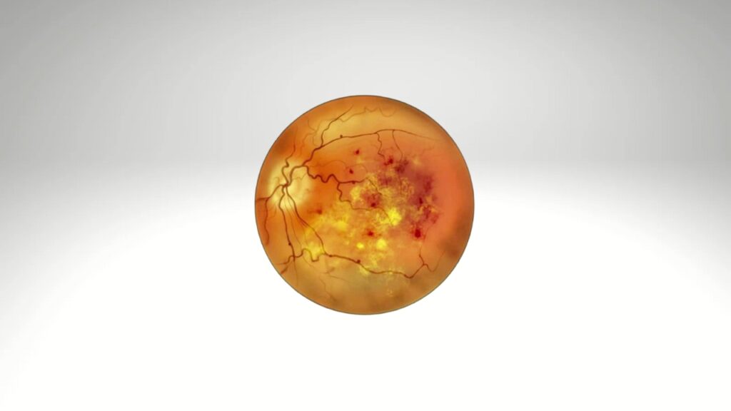 Rétinopathie (1280 x 720 px)